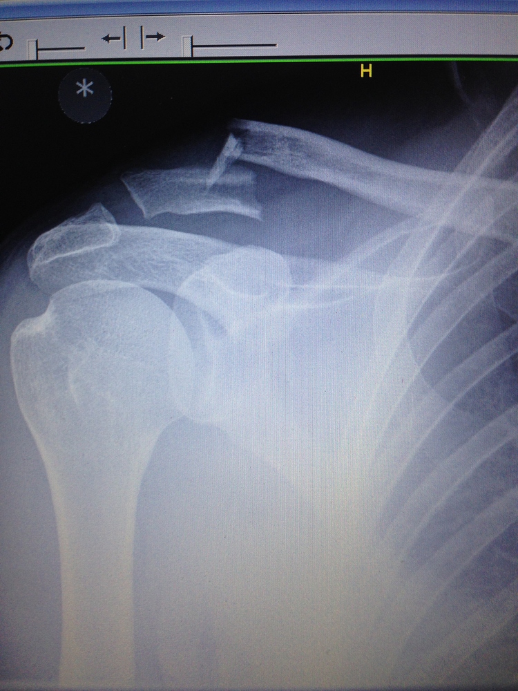 How To Repair A Broken Collarbone