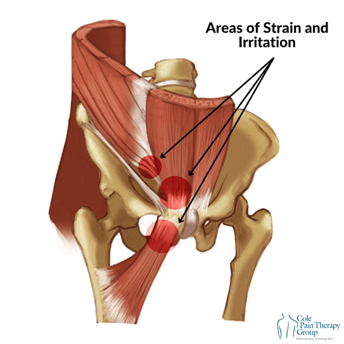 Athletic-Pubalgia-1-768x768